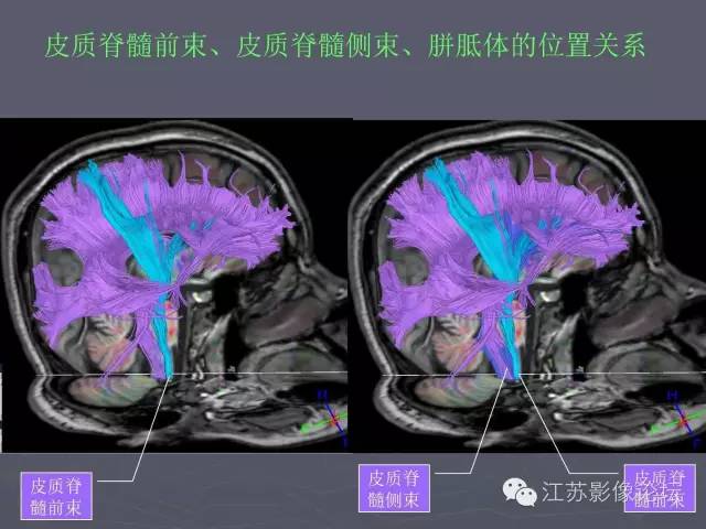 【PPT】磁共振DTI成像-投射纤维