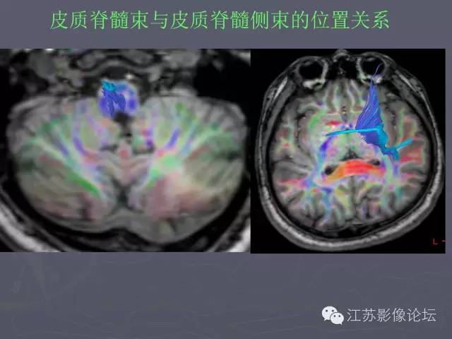 【PPT】磁共振DTI成像-投射纤维
