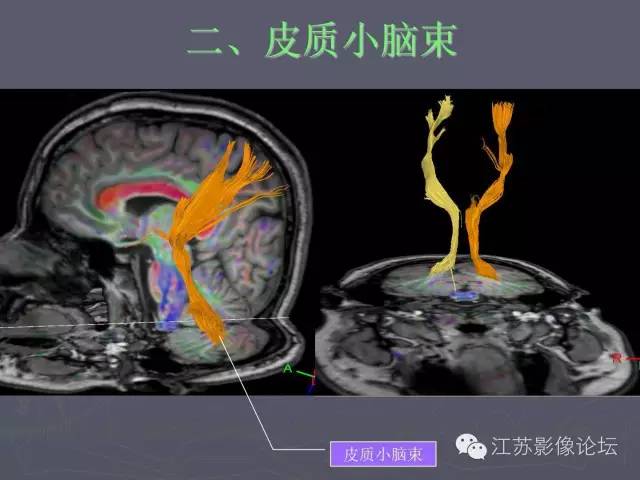 【PPT】磁共振DTI成像-投射纤维