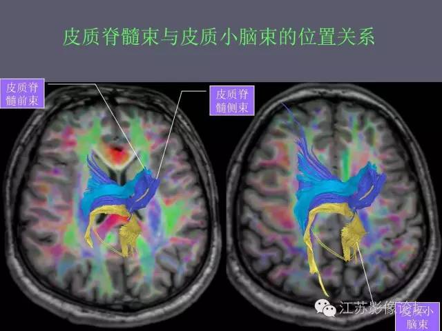 【PPT】磁共振DTI成像-投射纤维