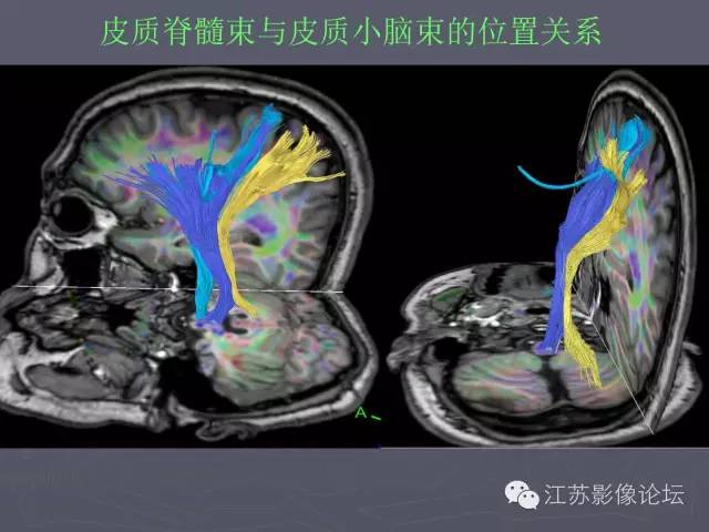 【PPT】磁共振DTI成像-投射纤维