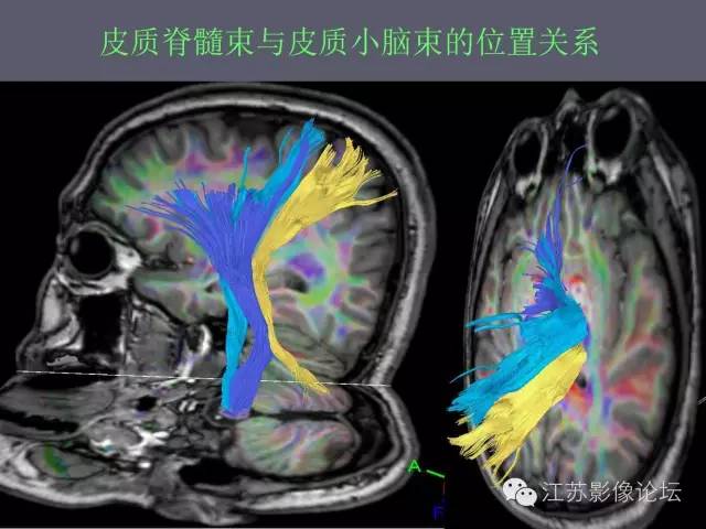 【PPT】磁共振DTI成像-投射纤维
