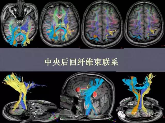 【PPT】磁共振DTI成像-投射纤维