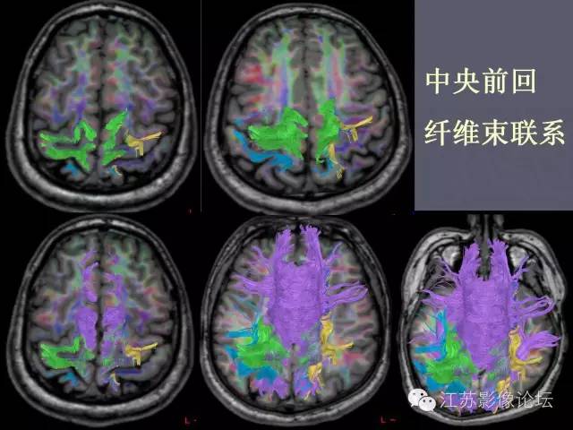 【PPT】磁共振DTI成像-投射纤维