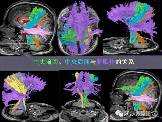 【PPT】磁共振DTI成像-投射纤维