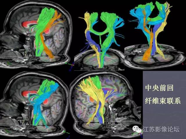 【PPT】磁共振DTI成像-投射纤维