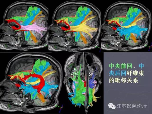 【PPT】磁共振DTI成像-投射纤维
