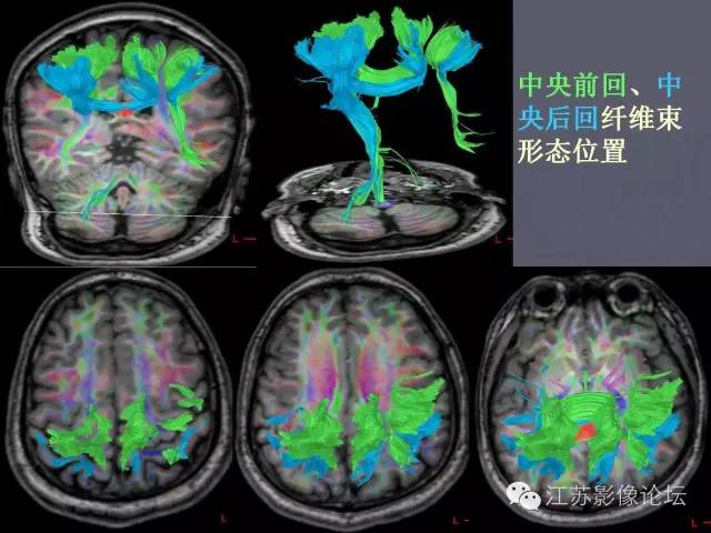 【PPT】磁共振DTI成像-投射纤维