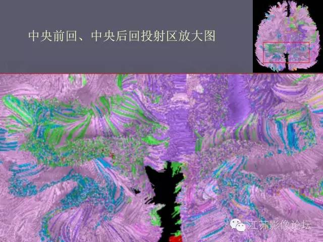 【PPT】磁共振DTI成像-投射纤维