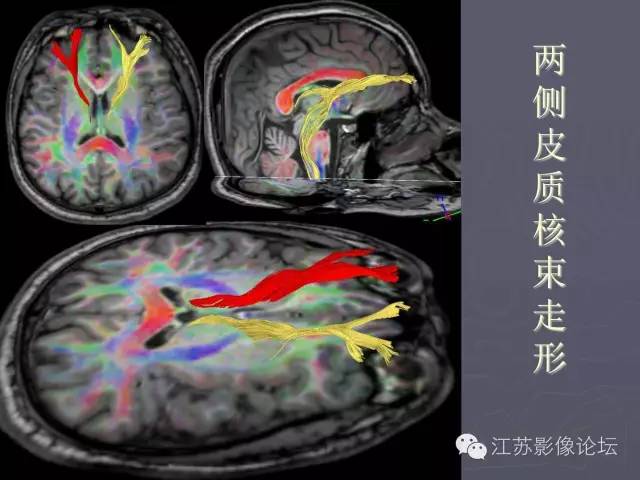 【PPT】磁共振DTI成像-投射纤维