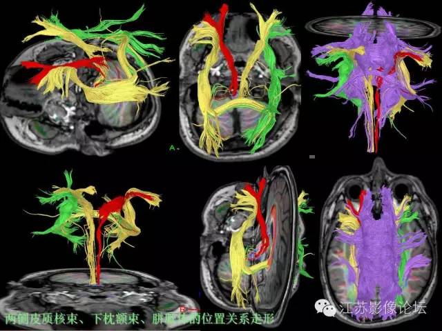 【PPT】磁共振DTI成像-投射纤维