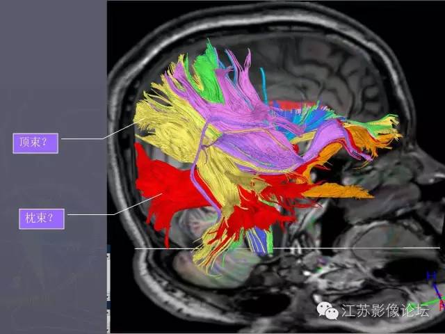 【PPT】磁共振DTI成像-投射纤维