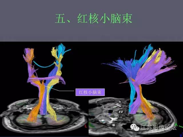 【PPT】磁共振DTI成像-投射纤维