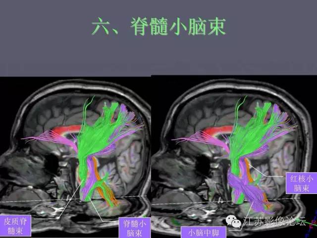 【PPT】磁共振DTI成像-投射纤维