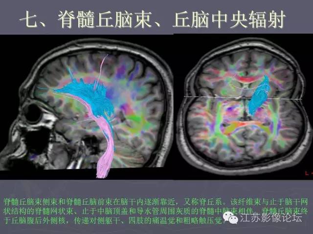 【PPT】磁共振DTI成像-投射纤维