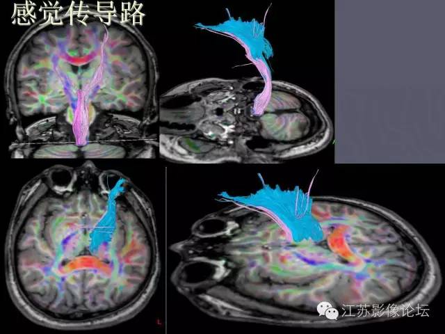 【PPT】磁共振DTI成像-投射纤维