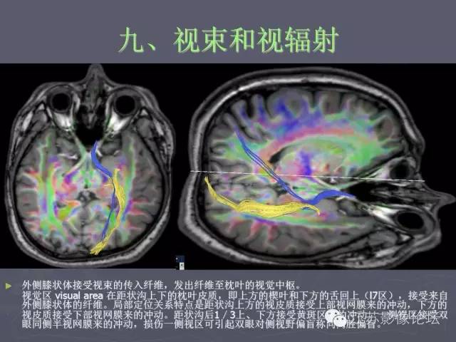 【PPT】磁共振DTI成像-投射纤维