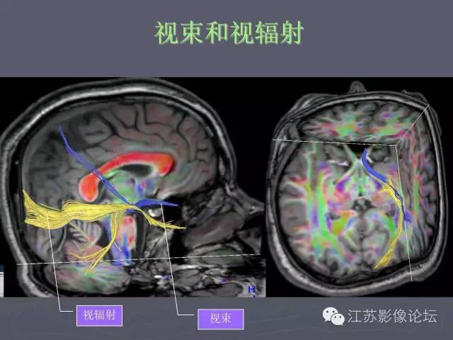 【PPT】磁共振DTI成像-投射纤维