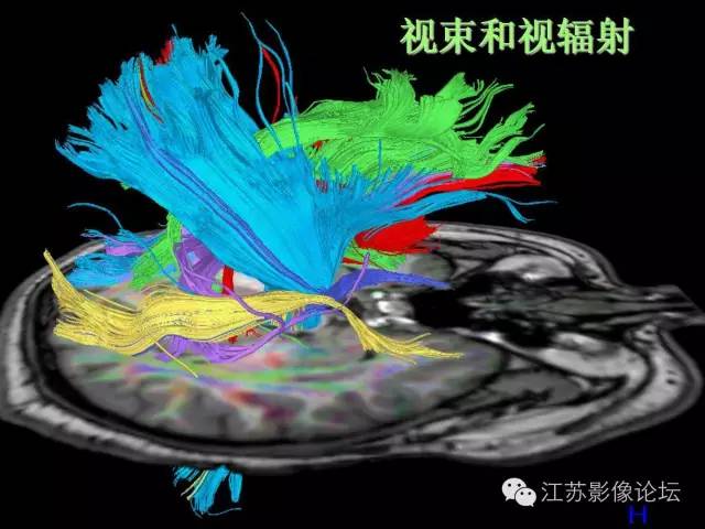 【PPT】磁共振DTI成像-投射纤维