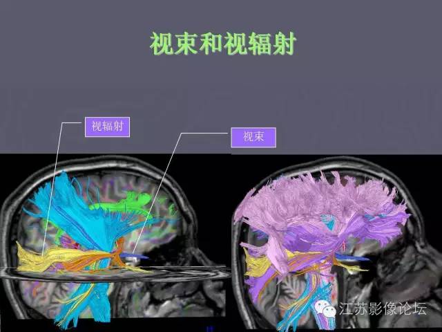 【PPT】磁共振DTI成像-投射纤维
