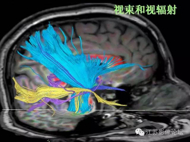 【PPT】磁共振DTI成像-投射纤维
