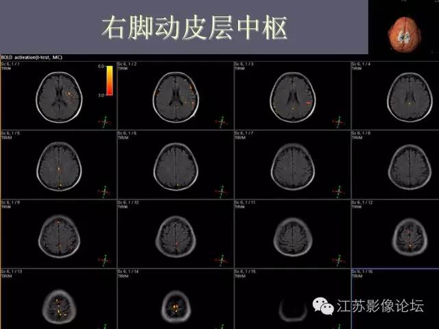 【PPT】磁共振DTI成像-投射纤维