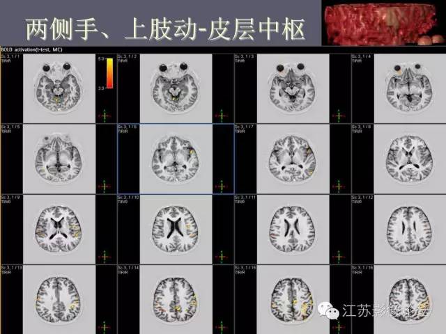 【PPT】磁共振DTI成像-投射纤维