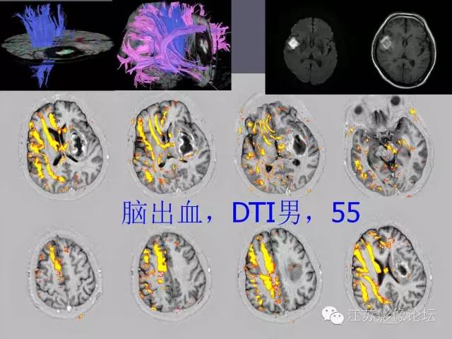 【PPT】磁共振DTI成像-投射纤维