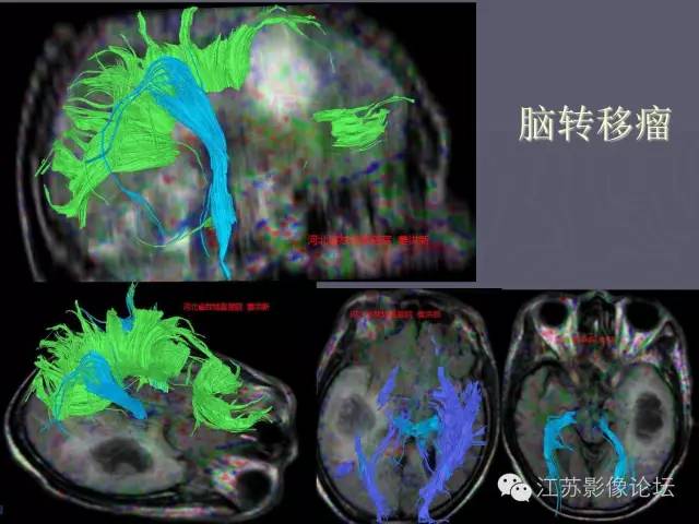 【PPT】磁共振DTI成像-投射纤维