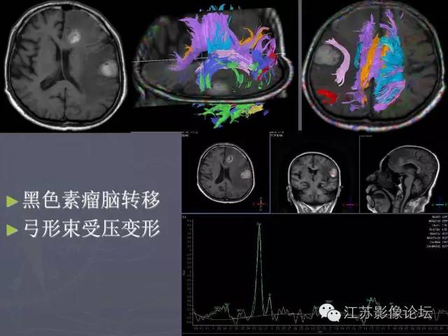 【PPT】磁共振DTI成像-投射纤维