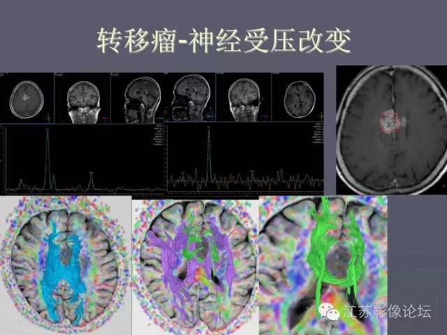 【PPT】磁共振DTI成像-投射纤维