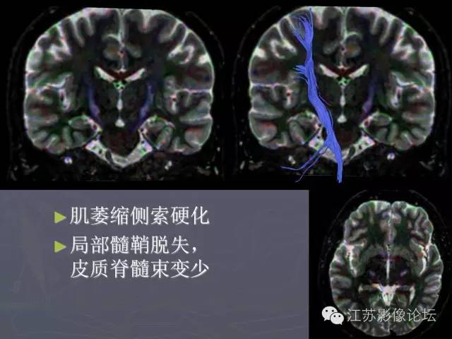 【PPT】磁共振DTI成像-投射纤维