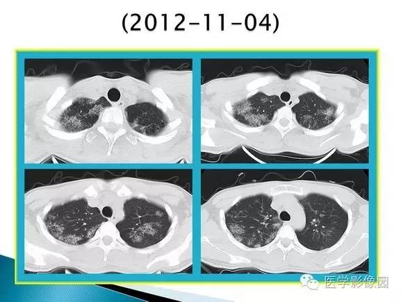 【病例】肺泡蛋白沉着症1例CT影像表现