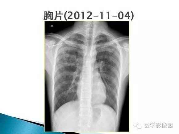 【病例】肺泡蛋白沉着症1例CT影像表现