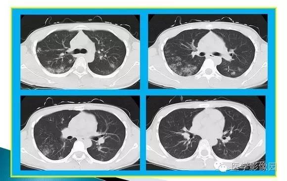 【病例】肺泡蛋白沉着症1例CT影像表现
