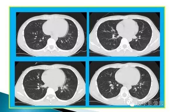 【病例】肺泡蛋白沉着症1例CT影像表现