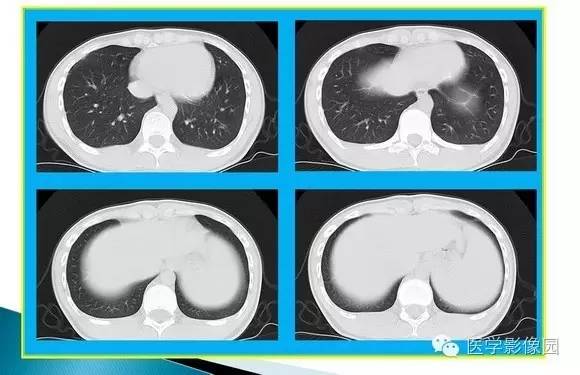 【病例】肺泡蛋白沉着症1例CT影像表现
