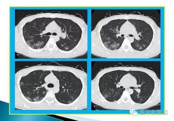 【病例】肺泡蛋白沉着症1例CT影像表现