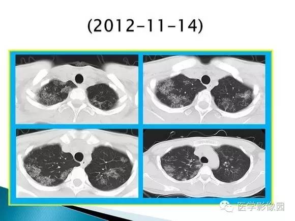 【病例】肺泡蛋白沉着症1例CT影像表现