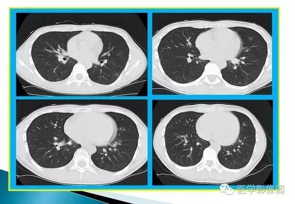 【病例】肺泡蛋白沉着症1例CT影像表现