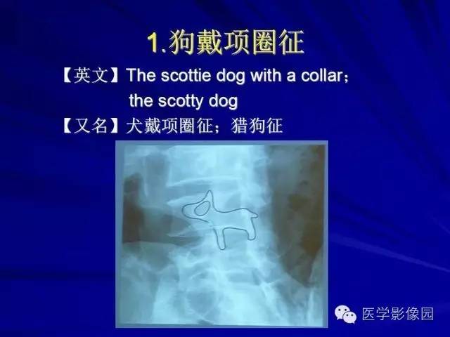 【PPT】脊柱各种征象的介绍