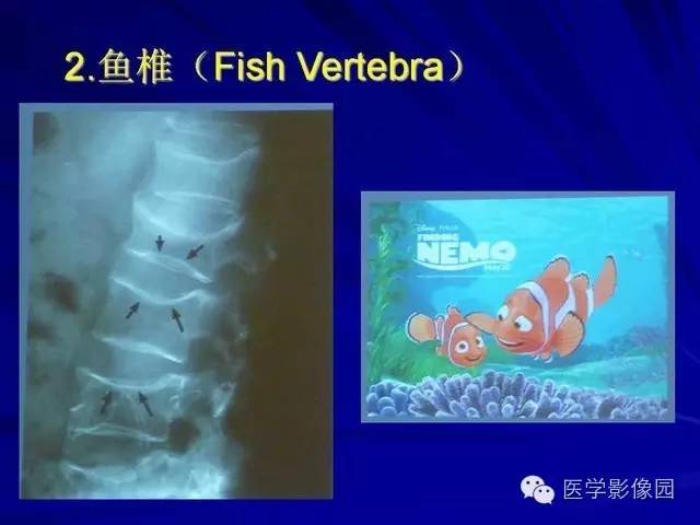 【PPT】脊柱各种征象的介绍