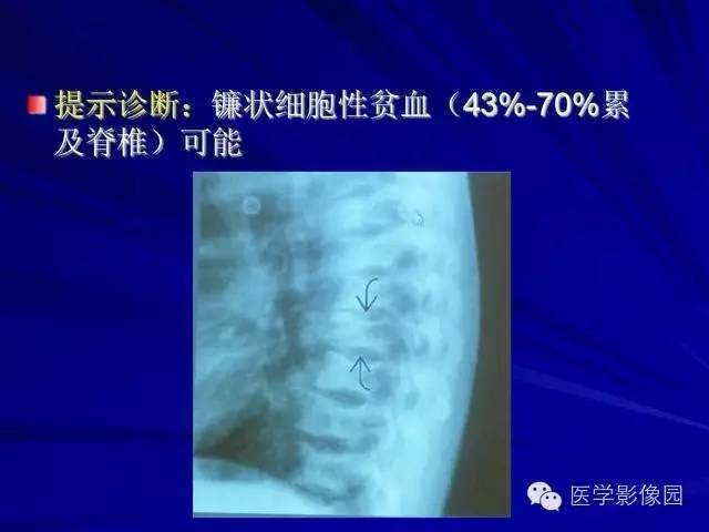 【PPT】脊柱各种征象的介绍