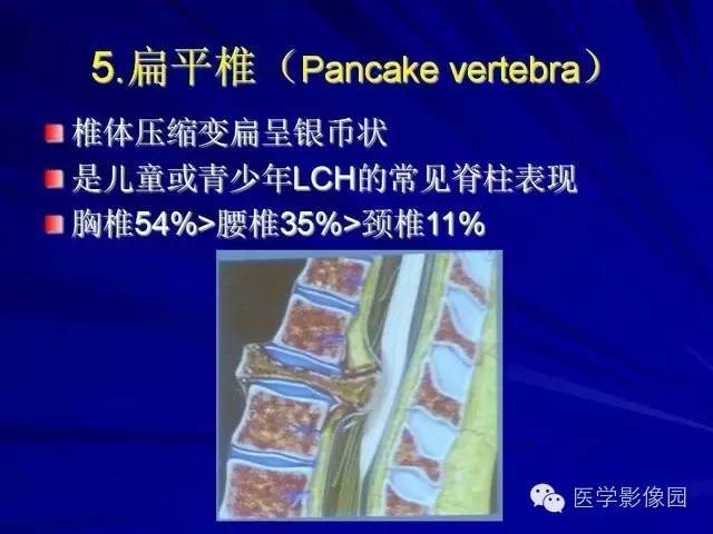 【PPT】脊柱各种征象的介绍