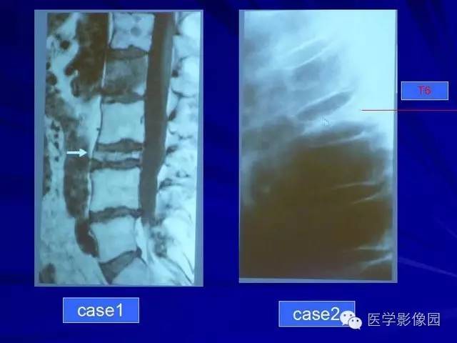 【PPT】脊柱各种征象的介绍