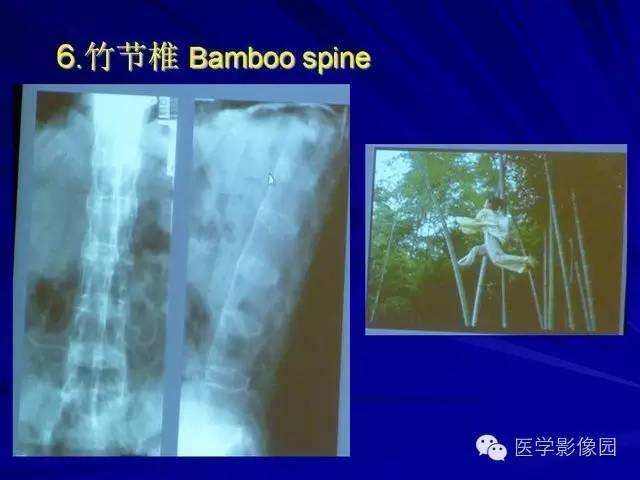 【PPT】脊柱各种征象的介绍