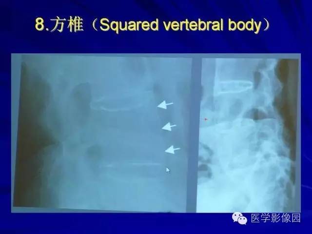 【PPT】脊柱各种征象的介绍