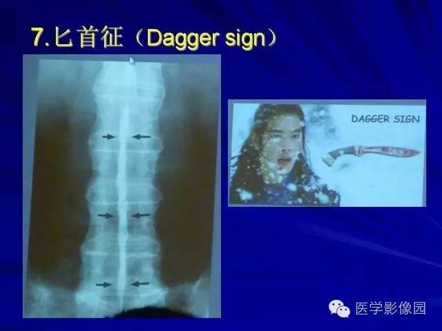 【PPT】脊柱各种征象的介绍