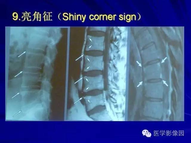 【PPT】脊柱各种征象的介绍