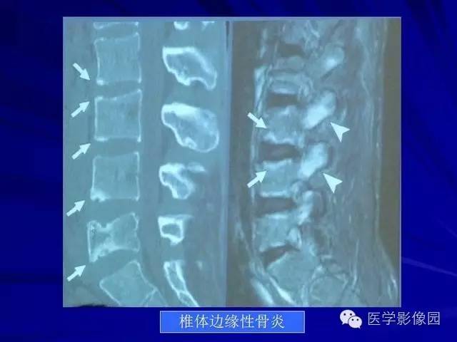 【PPT】脊柱各种征象的介绍